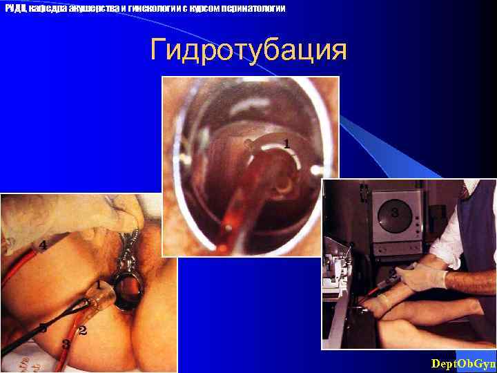 РУДН, кафедра акушерства и гинекологии с курсом перинатологии Гидротубация Dept. Ob. Gyn 