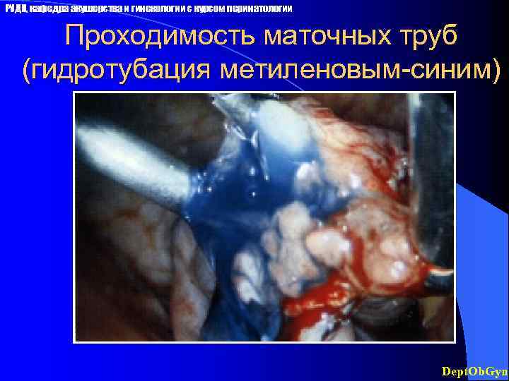 РУДН, кафедра акушерства и гинекологии с курсом перинатологии Проходимость маточных труб (гидротубация метиленовым-синим) Dept.