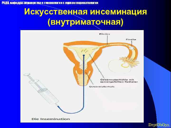 Инсеминация. Внутриматочная инсеминация. Искусственной инсеминации. Внутривлагалищная инсеминация.