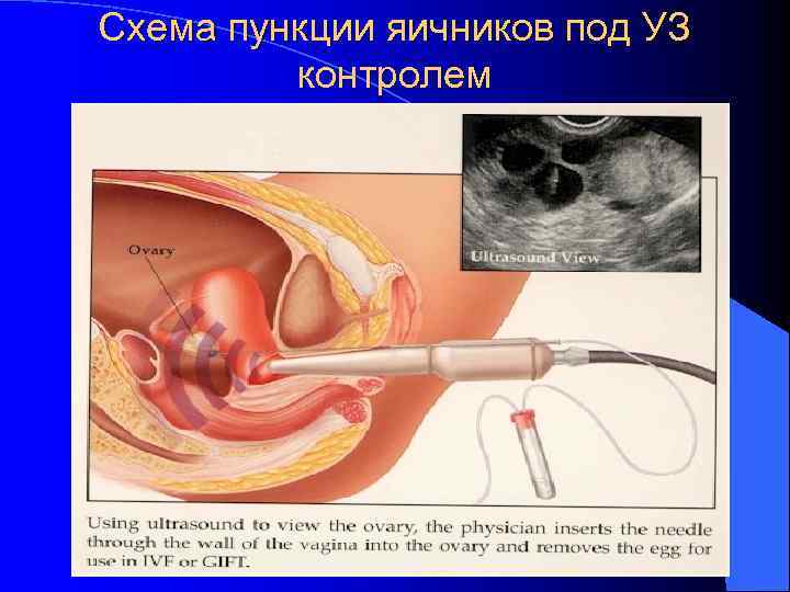 Схема пункции яичников под УЗ контролем 