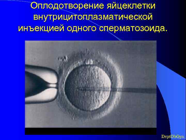 Оплодотворение яйцеклетки внутрицитоплазматической инъекцией одного сперматозоида. Dept. Ob. Gyn 