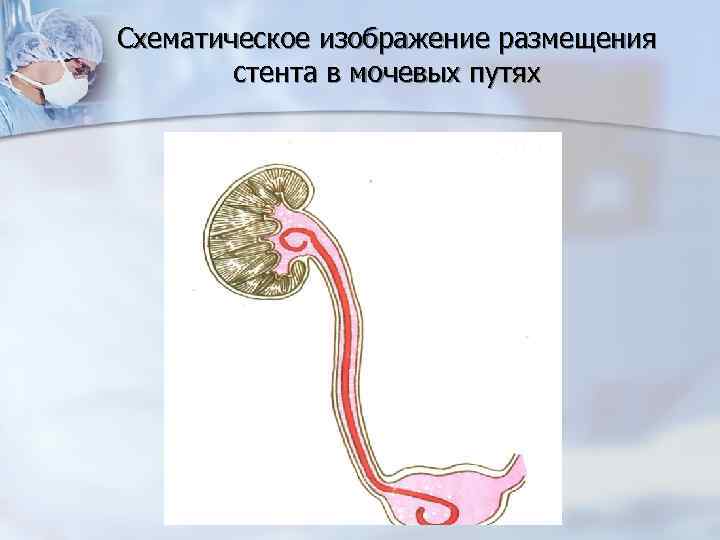 Схематическое изображение размещения стента в мочевых путях 