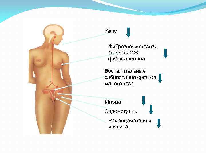 Aкне Фиброзно-кистозная болезнь МЖ, фиброаденома Воспалительные заболевания органов малого таза Миома Эндометриоз Рак эндометрия
