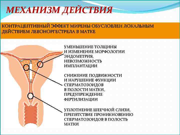 МЕХАНИЗМ ДЕЙСТВИЯ КОНТРАЦЕПТИВНЫЙ ЭФФЕКТ МИРЕНЫ ОБУСЛОВЛЕН ЛОКАЛЬНЫМ ДЕЙСТВИЕМ ЛЕВОНОРГЕСТРЕЛА В МАТКЕ УМЕНЬШЕНИЕ ТОЛЩИНЫ И