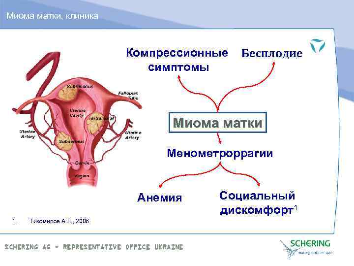 Миома матки, клиника Компрессионные симптомы Бесплодие Миома матки Менометроррагии Анемия 1. Тихомиров А. Л.