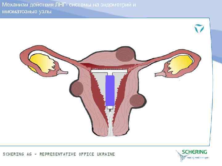 Механизм действия ЛНГ- системы на эндометрий и миоматозные узлы SCHERING AG – REPRESENTATIVE OFFICE