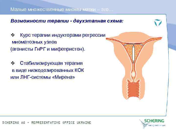 Малые множественные миомы матки – это… Возможности терапии - двухэтапная схема: v Курс терапии