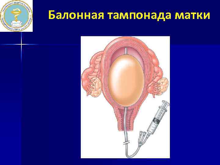 Балонная тампонада матки 