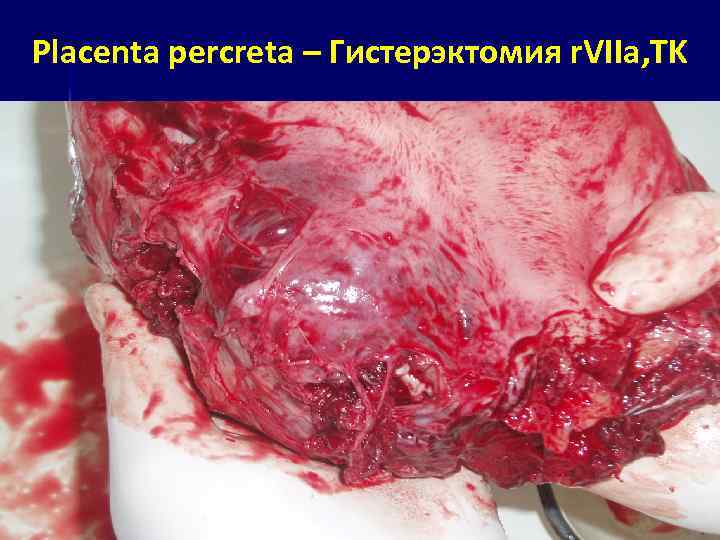 Placenta percreta – Гистерэктомия r. VIIa, TK 