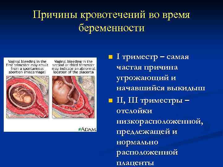 Причины кровотечений во время беременности n n I триместр – самая частая причина угрожающий