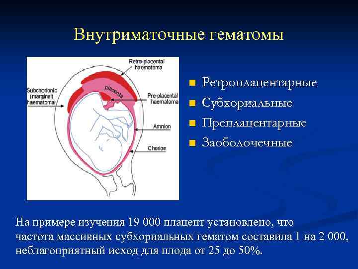 Внутриматочные гематомы n n Ретроплацентарные Субхориальные Преплацентарные Заоболочечные На примере изучения 19 000 плацент