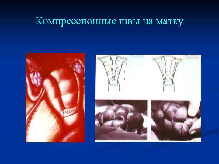 Компрессионные швы на матку 