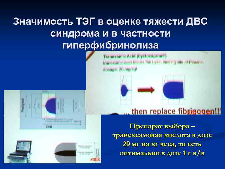 Значимость ТЭГ в оценке тяжести ДВС синдрома и в частности гиперфибринолиза Препарат выбора –