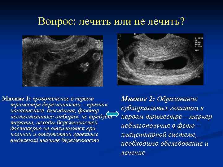 Вопрос: лечить или не лечить? Мнение 1: кровотечение в первом триместре беременности – признак