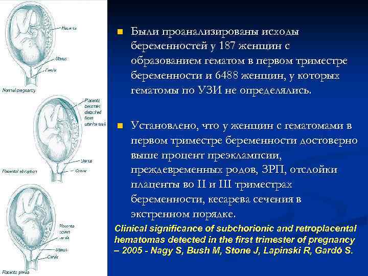 n Были проанализированы исходы беременностей у 187 женщин с образованием гематом в первом триместре