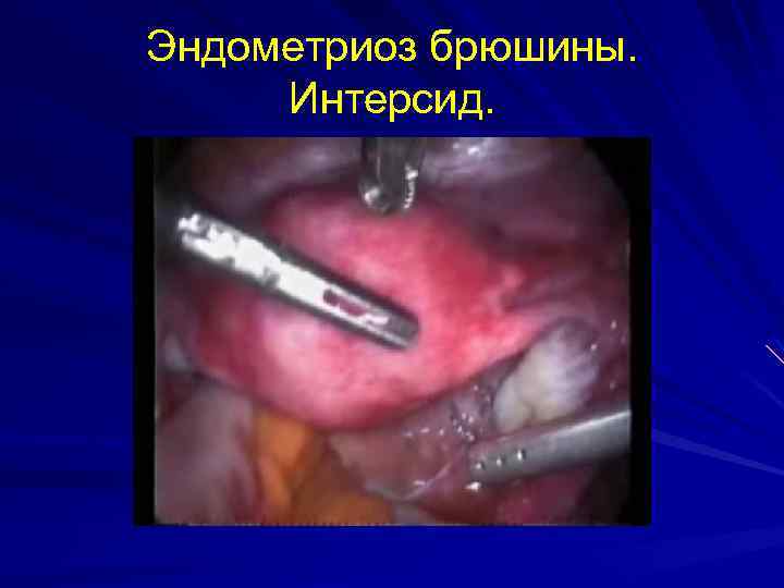 Эндометриоз брюшины. Интерсид. 