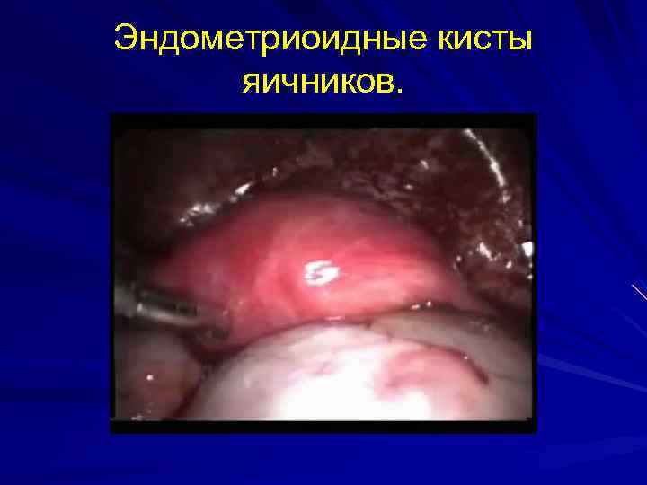 Эндометриоидные кисты яичников. 