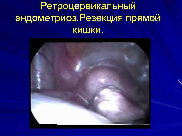 Ретроцервикальный эндометриоз. Резекция прямой кишки. 