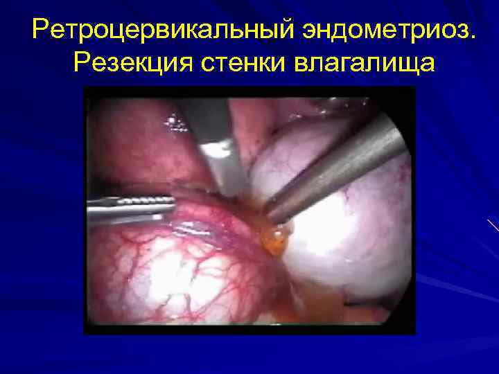 Ретроцервикальный эндометриоз. Резекция стенки влагалища 