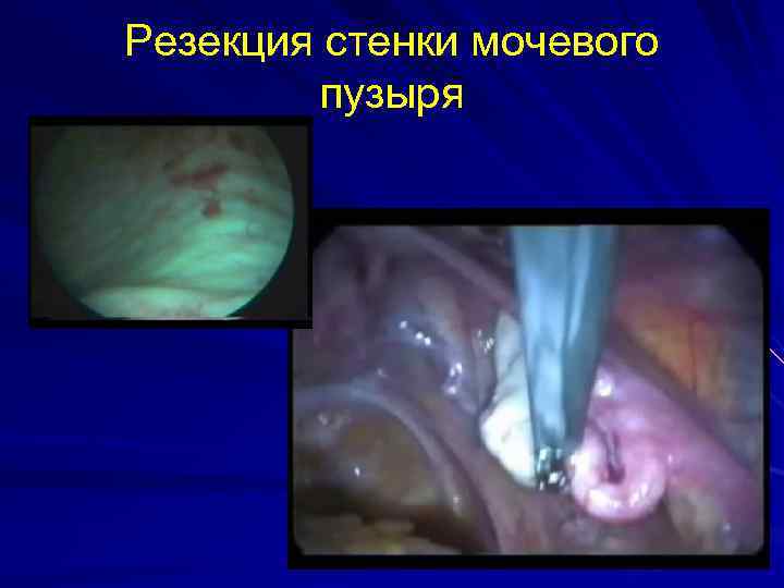 Резекция стенки мочевого пузыря 