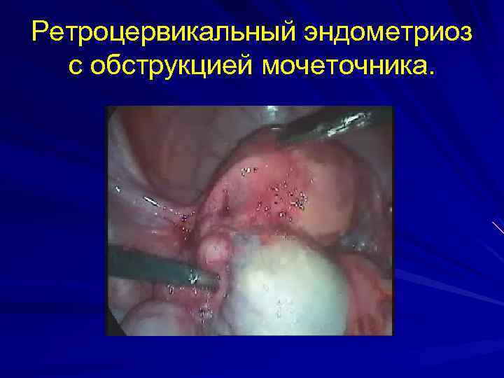 Ретроцервикальный эндометриоз с обструкцией мочеточника. 