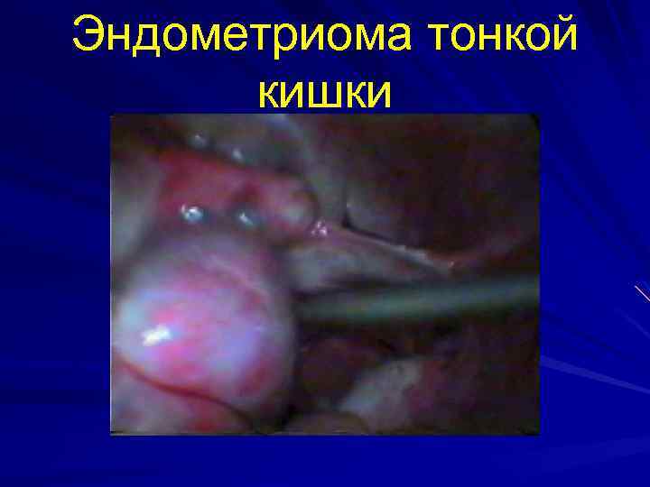 Эндометриома тонкой кишки 
