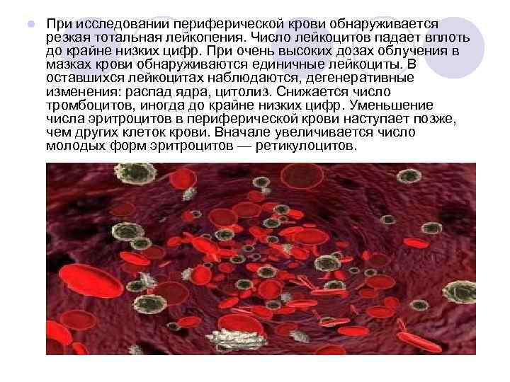 l При исследовании периферической крови обнаруживается резкая тотальная лейкопения. Число лейкоцитов падает вплоть до