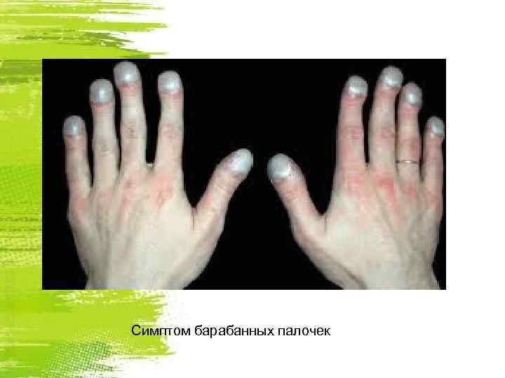 Симптом барабанных палочек 