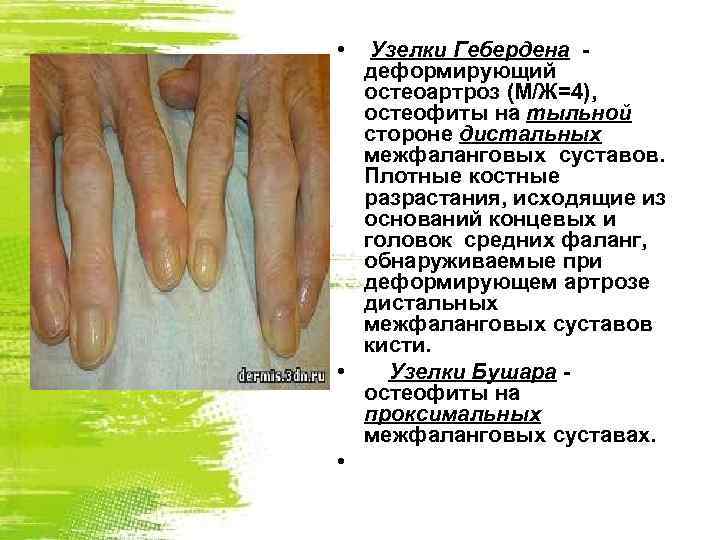  • Узелки Гебердена деформирующий остеоартроз (М/Ж=4), остеофиты на тыльной стороне дистальных межфаланговых суставов.