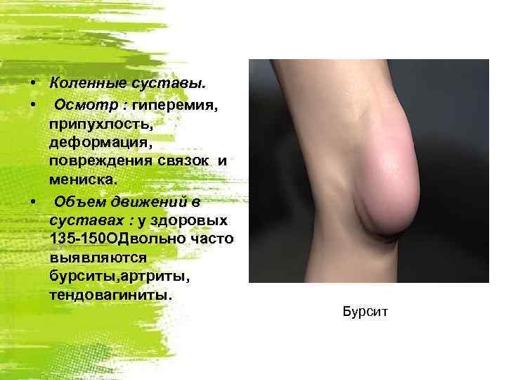  • Коленные суставы. • Осмотр : гиперемия, припухлость, деформация, повреждения связок и мениска.