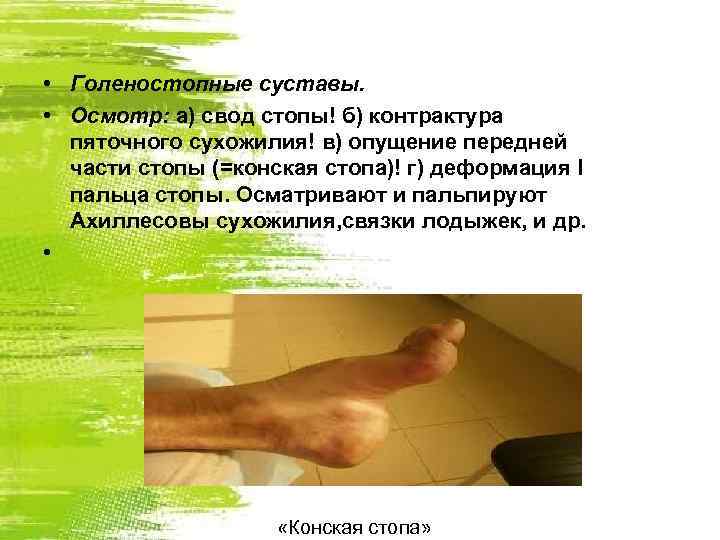  • Голеностопные суставы. • Осмотр: а) свод стопы! б) контрактура пяточного сухожилия! в)