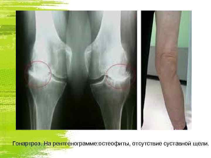 Гонартроз. На рентгенограмме: остеофиты, отсутствие суставной щели. 