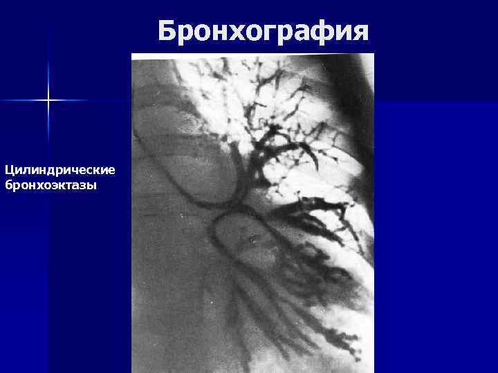 Бронхография Цилиндрические бронхоэктазы 