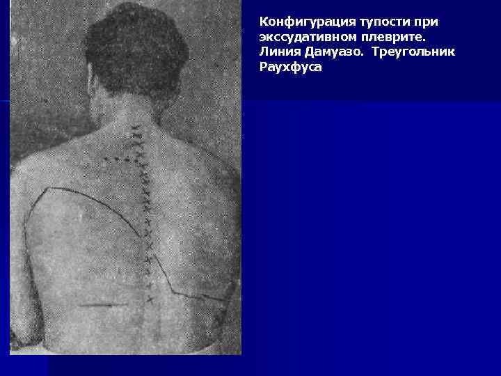 Конфигурация тупости при экссудативном плеврите. Линия Дамуазо. Треугольник Раухфуса 
