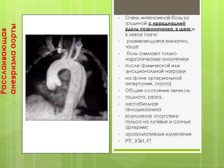 Расслаивающая аневризма аорты • • • Очень интенсивная боль за грудиной с иррадиацией вдоль