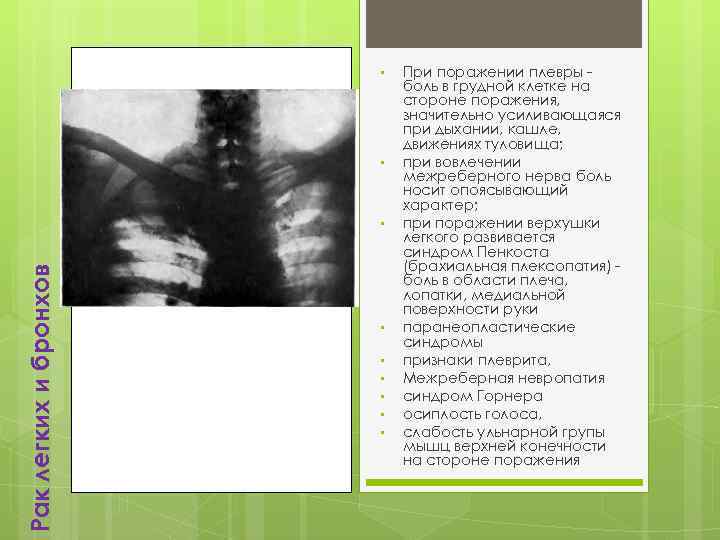  • • Рак легких и бронхов • • При поражении плевры боль в
