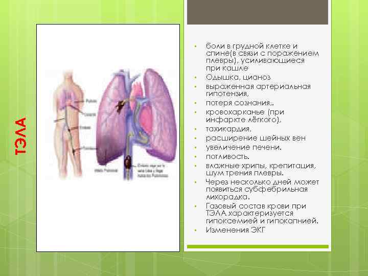  • • ТЭЛА • • • боли в грудной клетке и спине(в связи