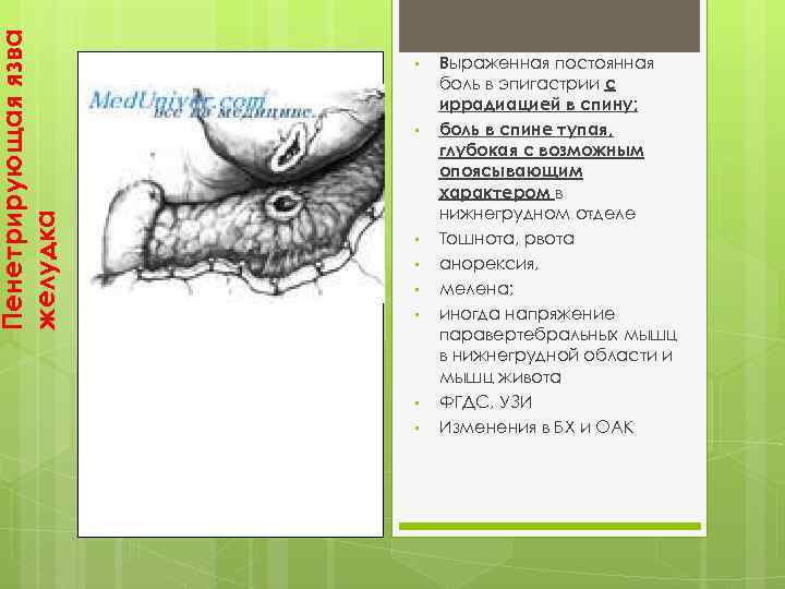 Пенетрирующая язва желудка • • Выраженная постоянная боль в эпигастрии с иррадиацией в спину;