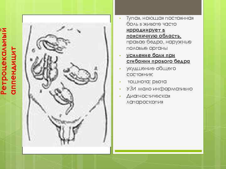 Ретроцекальный аппендицит • • • Тупая, ноющая постоянная боль в животе часто иррадиирует в