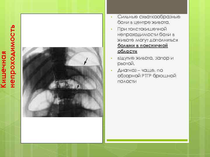 Кишечная непроходимость • • Сильные схваткообразные боли в центре живота, При толстокишечной непроходимости боли