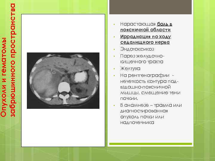 Опухоли и гематомы забрюшинного пространства • • Нарастающая боль в поясничной области Иррадиация по