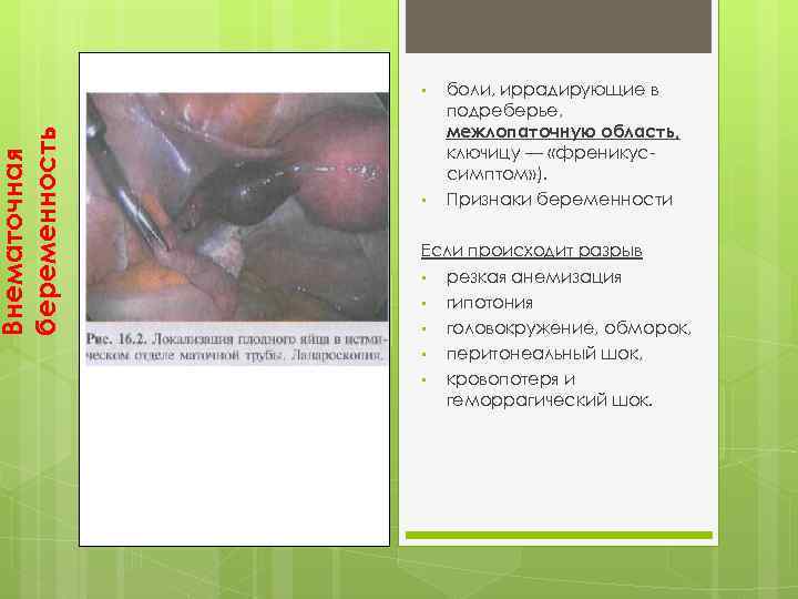 Внематочная беременность • • боли, иррадирующие в подреберье, межлопаточную область, ключицу — «френикус симптом»