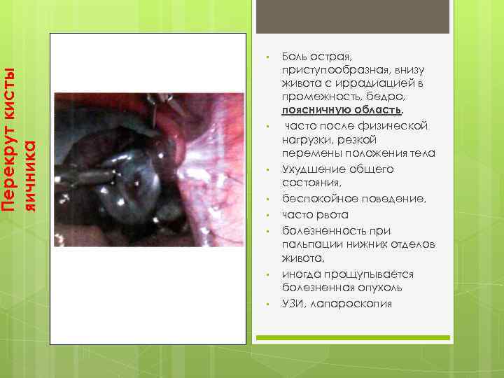 Перекрут кисты яичника • • Боль острая, приступообразная, внизу живота с иррадиацией в промежность,