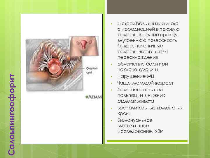  • Салоьпингоофорит • • • Острая боль внизу живота с иррадиацией в паховую