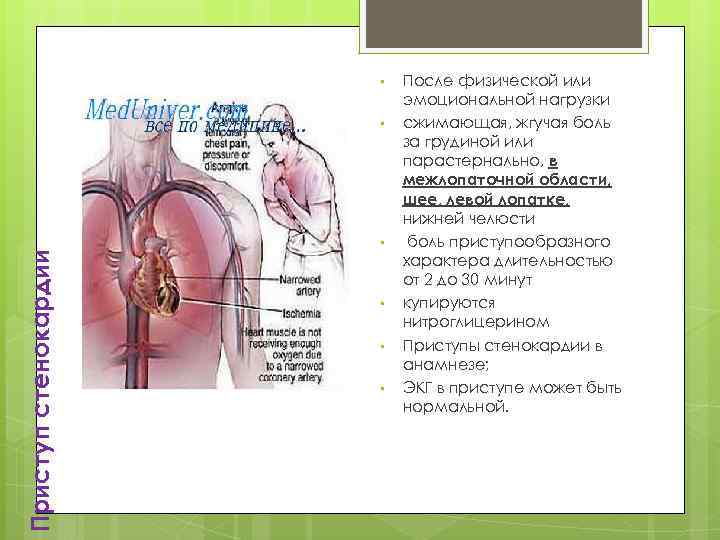  • Приступ стенокардии • • • После физической или эмоциональной нагрузки сжимающая, жгучая