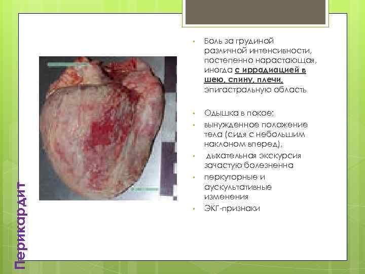  • Боль за грудиной различной интенсивности, постепенно нарастающая, иногда с иррадиацией в шею,
