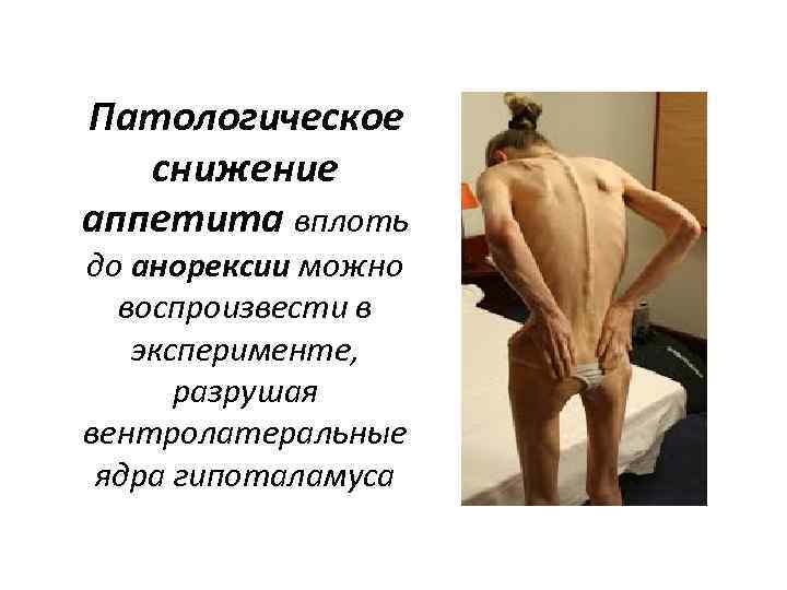 Патологическое снижение аппетита вплоть до анорексии можно воспроизвести в эксперименте, разрушая вентролатеральные ядра гипоталамуса