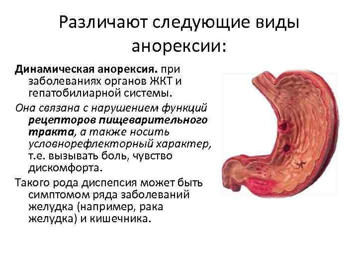 Различают следующие виды анорексии: Динамическая анорексия. при заболеваниях органов ЖКТ и гепатобилиарной системы. Она