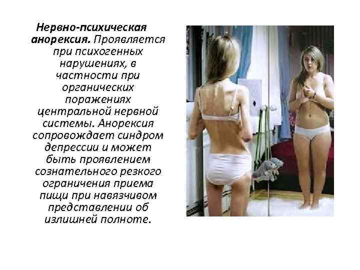 Нервно-психическая анорексия. Проявляется при психогенных нарушениях, в частности при органических поражениях центральной нервной системы.