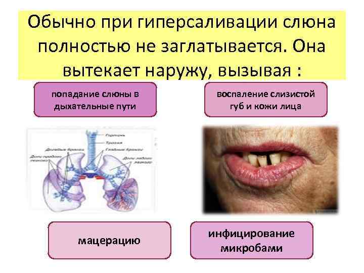 Обычно при гиперсаливации слюна полностью не заглатывается. Она вытекает наружу, вызывая : попадание слюны
